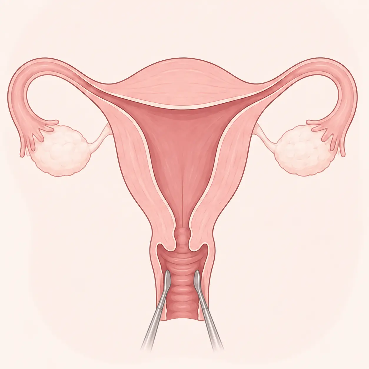 Illustration av vaginal kirurgisk åtkomst