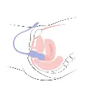 perifit-care-connected-perineal-probe.webp