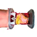 gastric-class-iv-2.webp