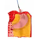 gastric-class-iii-2.webp