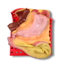 Gastric (Class IV)