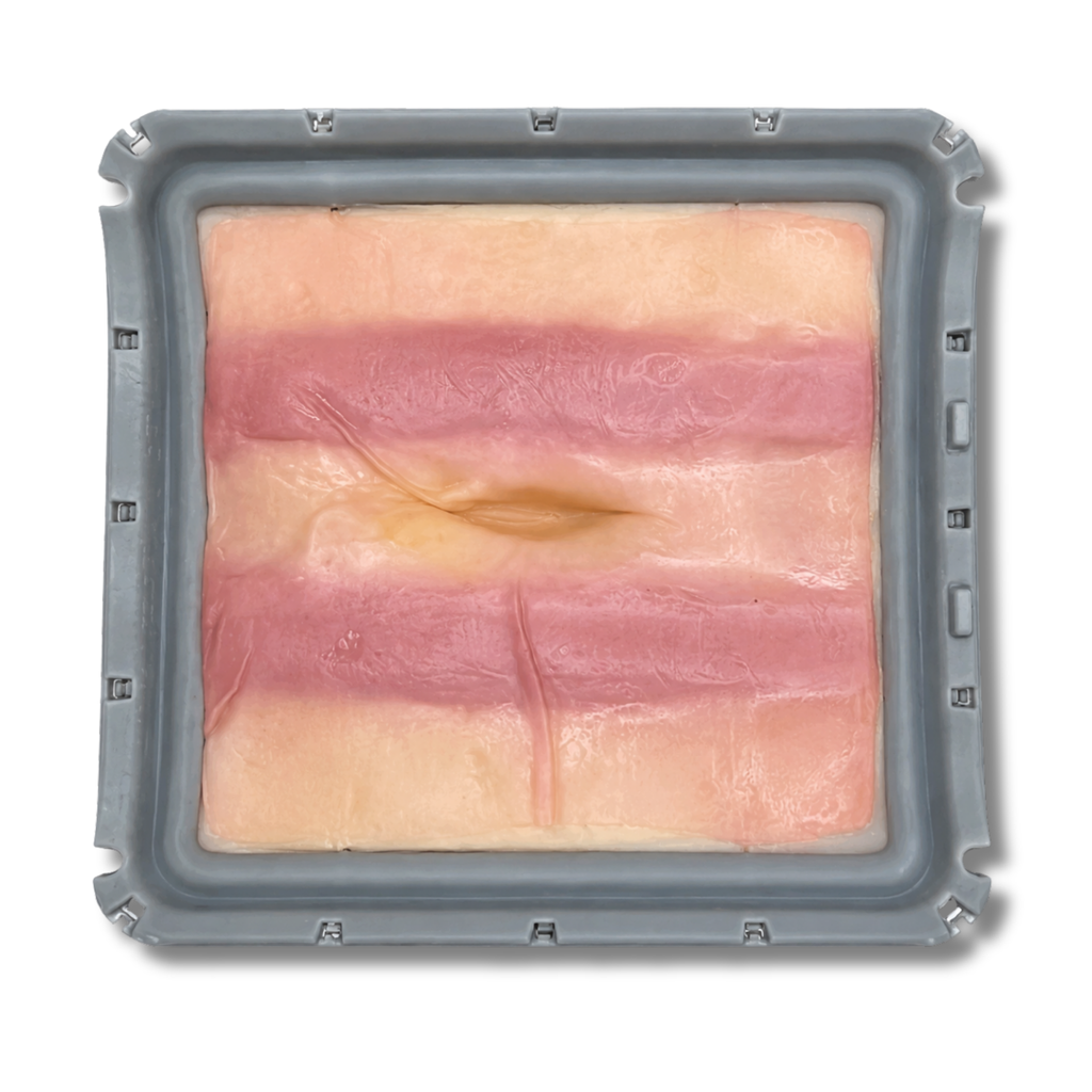 Ventral Hernia (Class II)