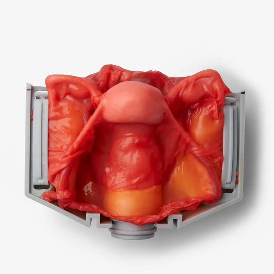 Hysterectomy (Class IV)