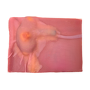 Partial Nephrectomy (Class IV)