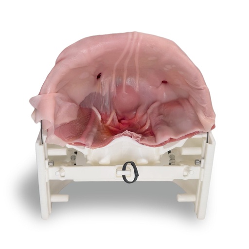 [GENINHIV] Inguinal Hernia (Class IV)
