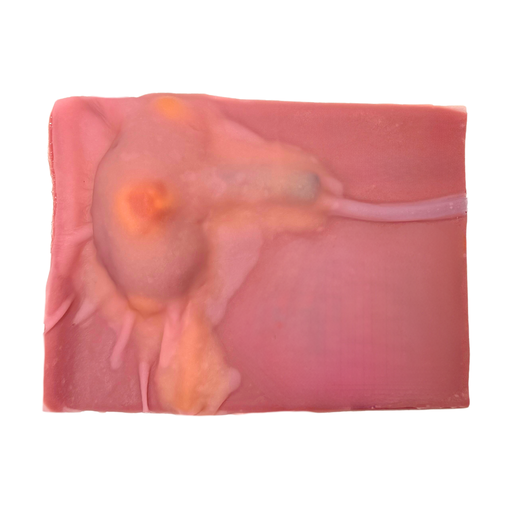 [UROPNPIV] Partial Nephrectomy (Class IV)