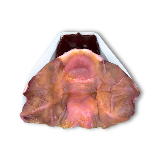 [UROPROSV] Prostatectomy (Class V)